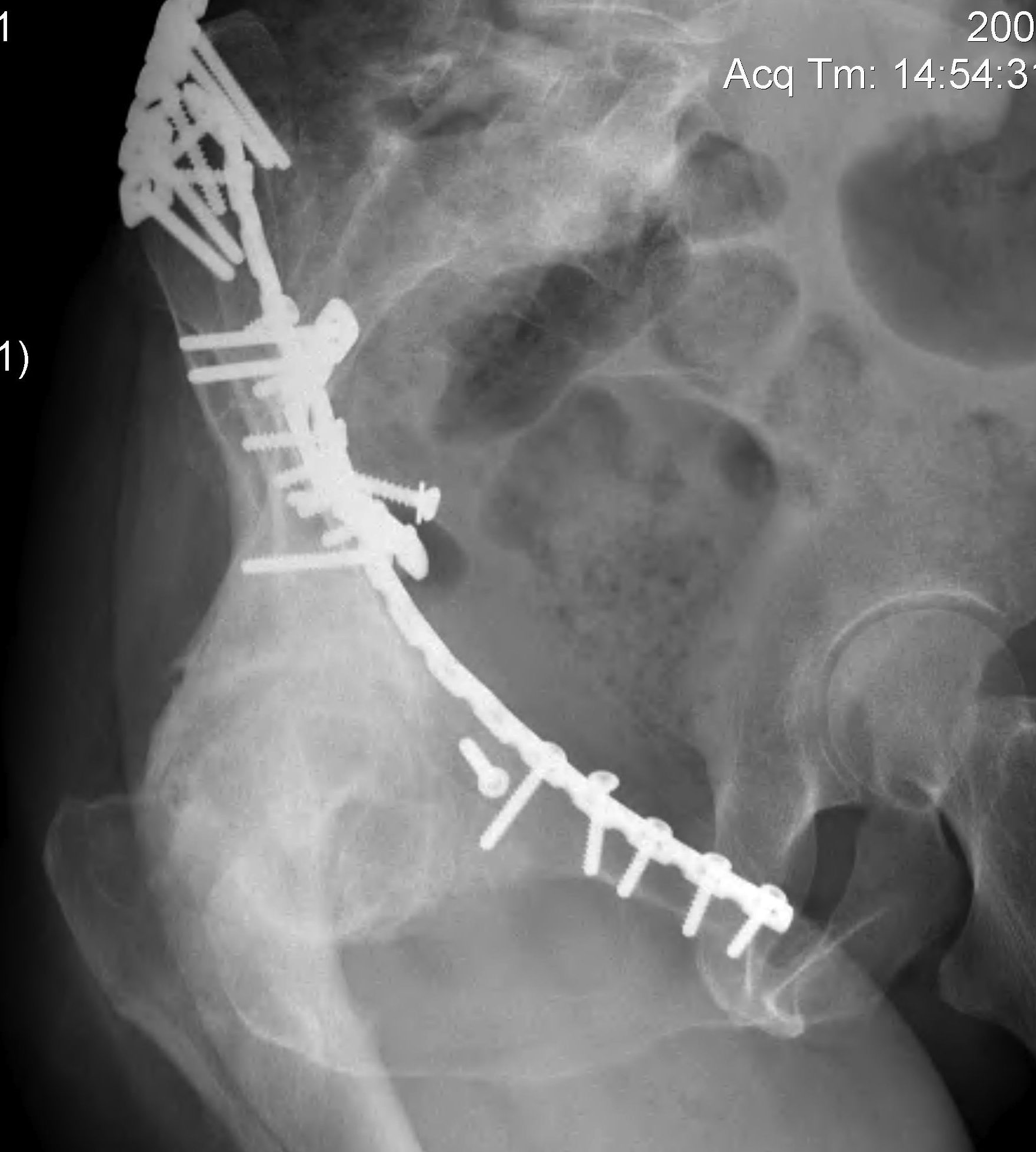 Hip OA post Acetabular Fracture